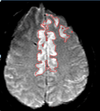 Core infarct volume